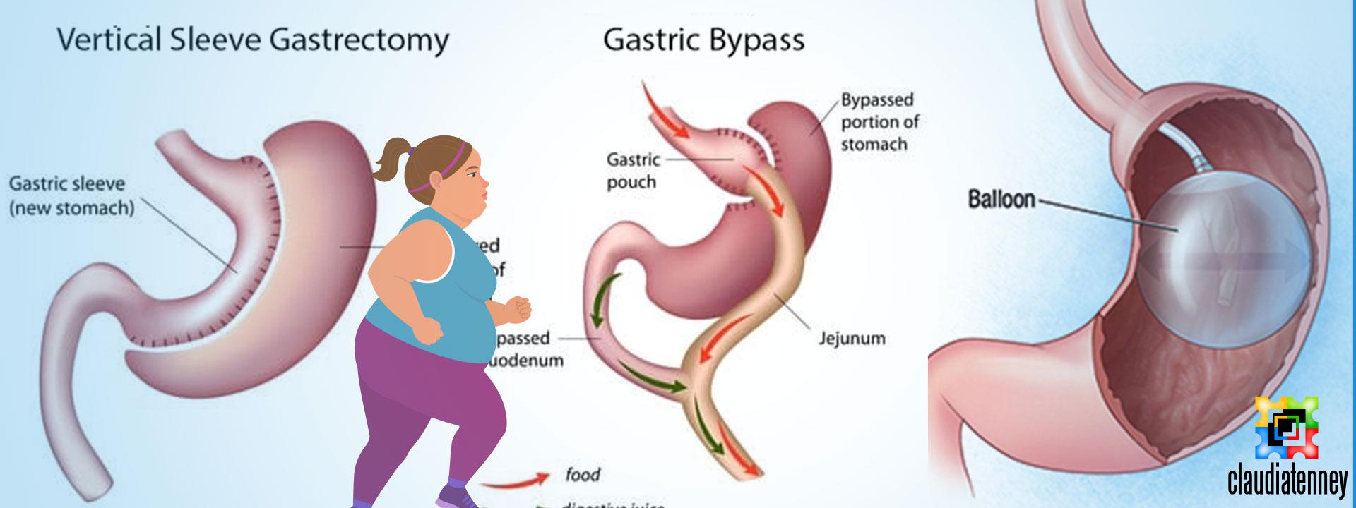 What Happens If You Eat Solid Food After Gastric Sleeve Surgery?