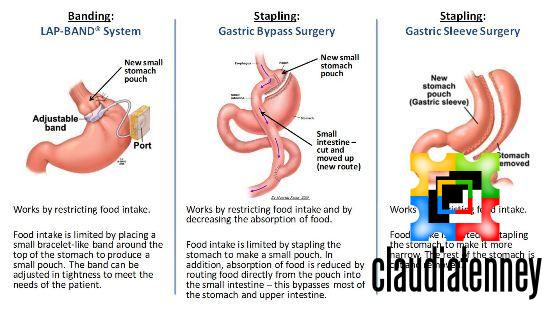 What Happens If You Eat Solid Food After Gastric Sleeve Surgery?