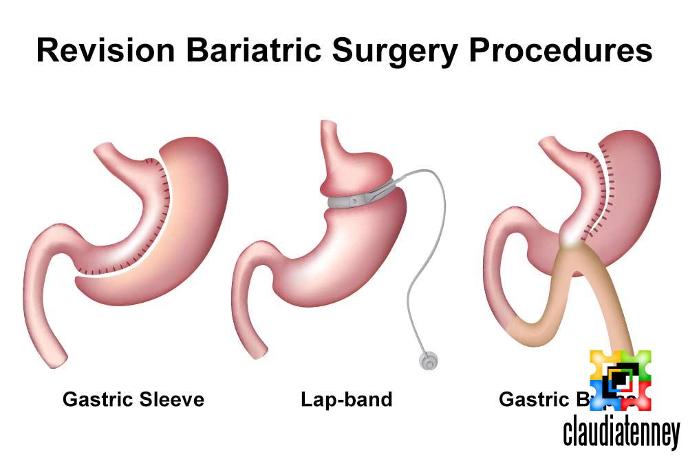 What Happens If You Eat Solid Food After Gastric Sleeve Surgery?